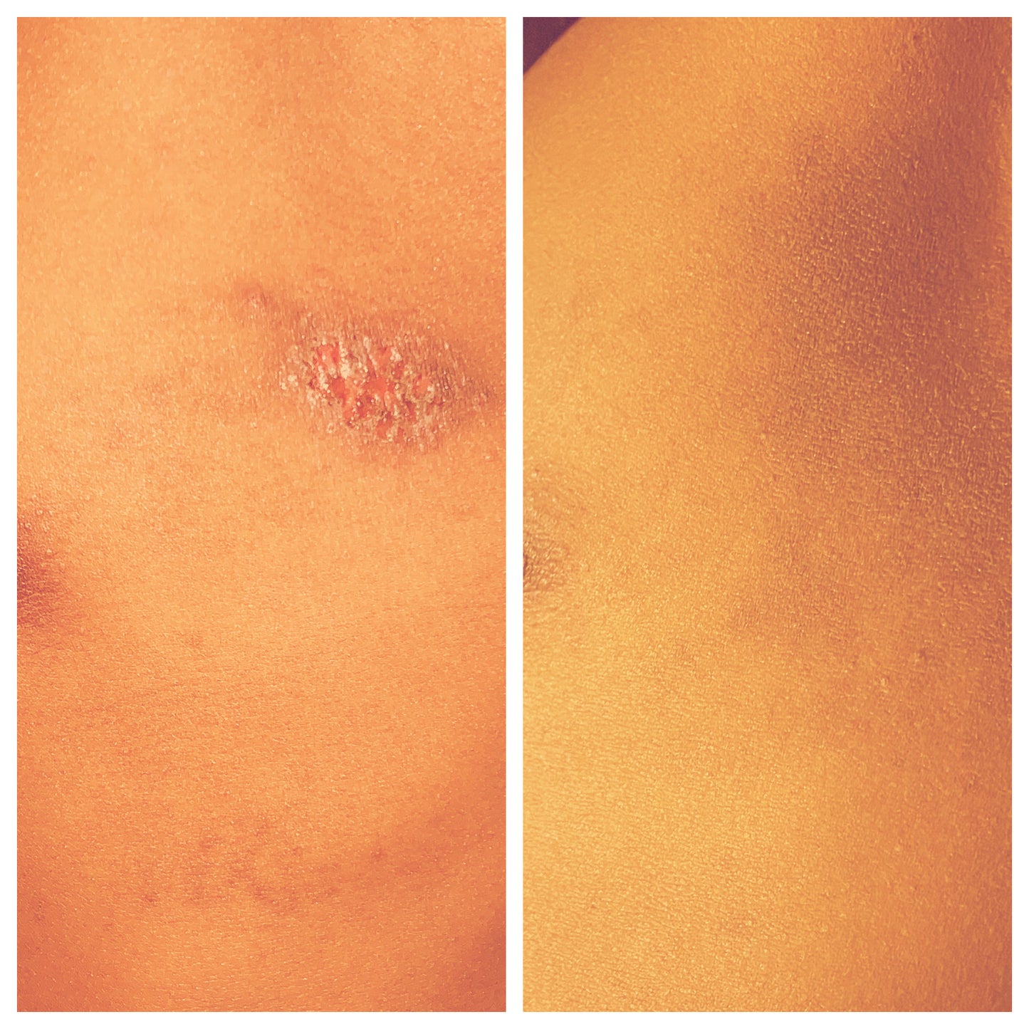 SkinSoothe Eczema & Psoriasis Relief Butter